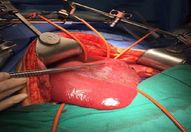 Liver Surgery