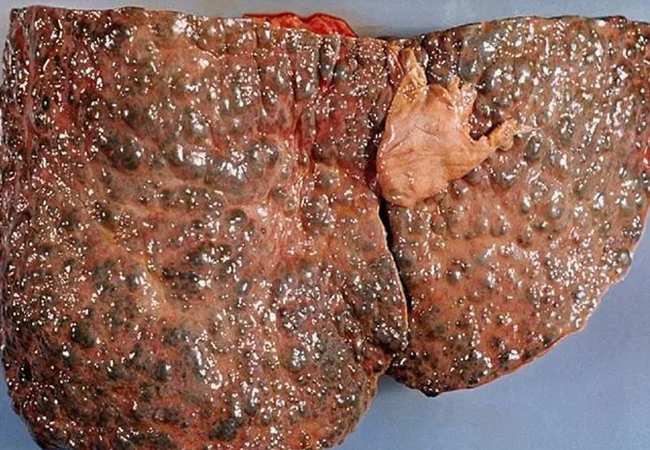 Chronic Liver Disease