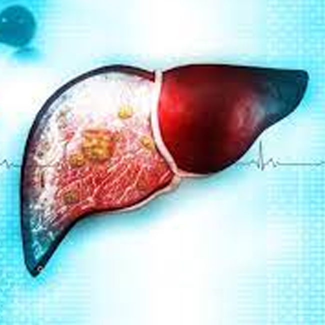 Chronic liver Disease (CLD)