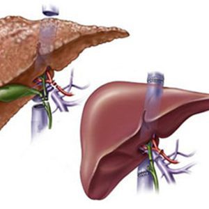 Best Liver Transplant Hospital/Surgeon in Noida