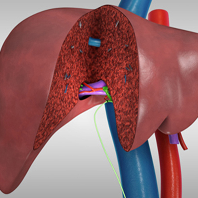 Living Donor Transplant