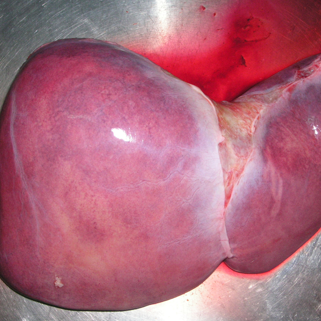 Liver Transplant